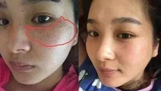 鼻子长痘是肝火还是胃火,鼻子长斑是情绪问题吗