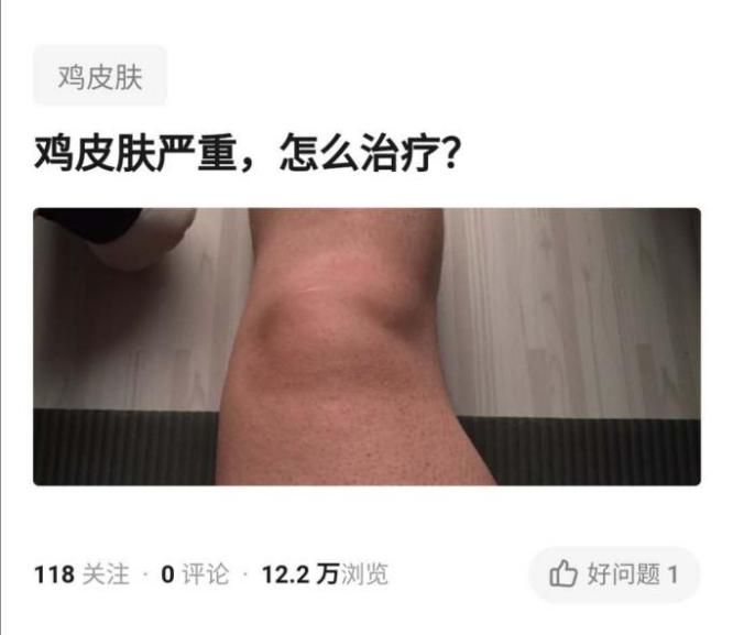 身上颗颗粒粒不光滑，美丽指数直线下降，讨人厌的鸡皮肤该咋办？