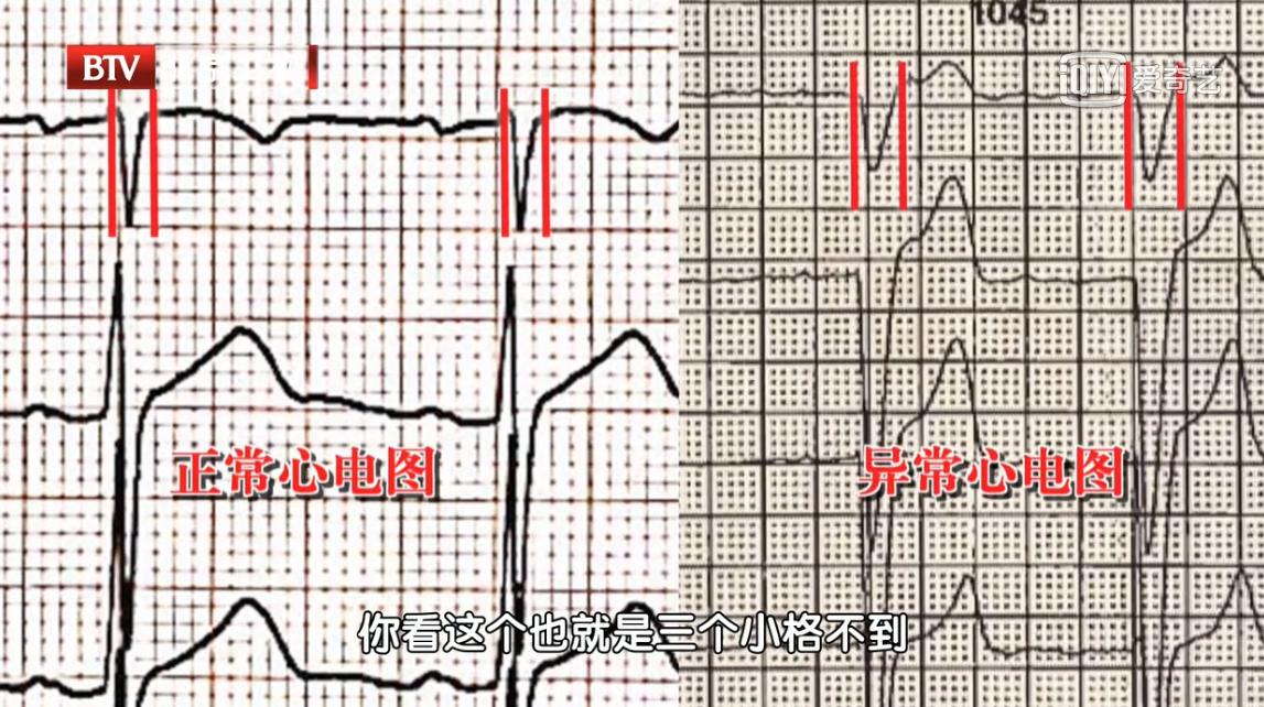 平躺胸闷憋气怎么回事,平躺胸闷怎么处理