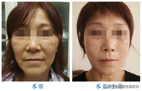 面部皮肤松弛下垂怎么改善,面部皮肤松弛下垂怎么恢复