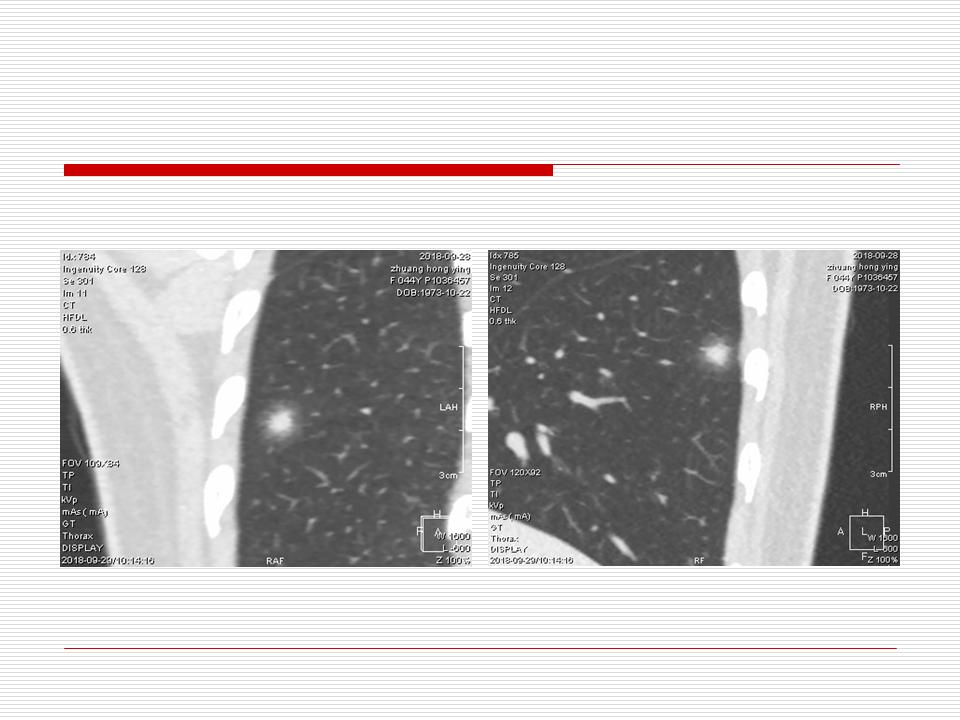 像炎症的肺癌能治好吗,医生说可能是肺癌也可能是炎症