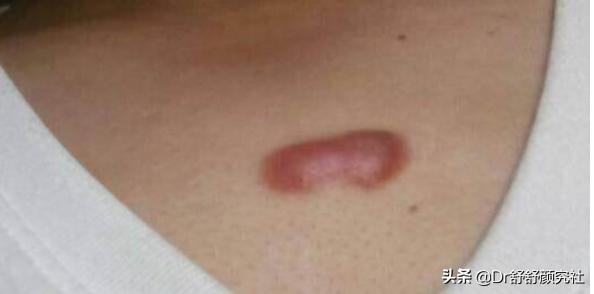 消除瘢痕疙瘩的药膏,胸口瘢痕疙瘩的危害