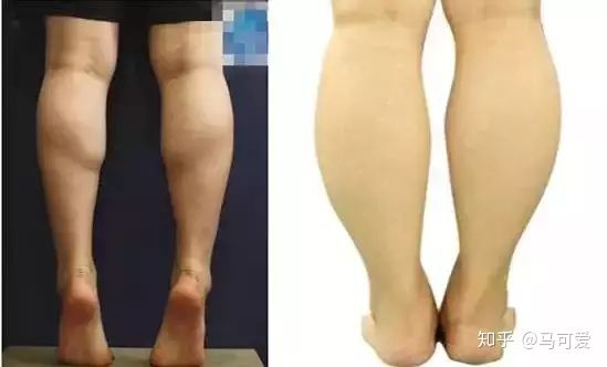 小腿粗脂肪腿如何变细腿,小腿粗可以瘦下去吗