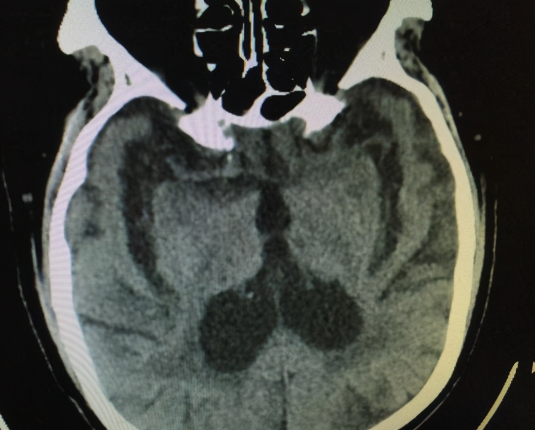 维生素b12可以预防脑萎缩吗,正常情况下多大年龄出现脑萎缩