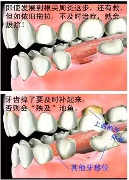 牙齿正面有小黑点千万不要忽视,不要小看牙齿的小黑点