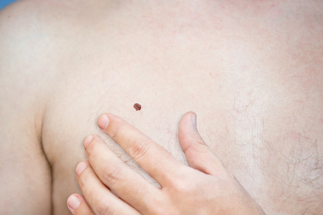 怎么祛痣不留疤痕的最好方法,脸祛痣的最好方法不留疤