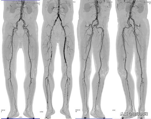 cta和血管造影怎么选择,血管oct检查与血管造影检查的区别