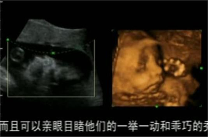 宝宝四维照片和生下来照片对比,四维照片所有宝宝都长得一样吗