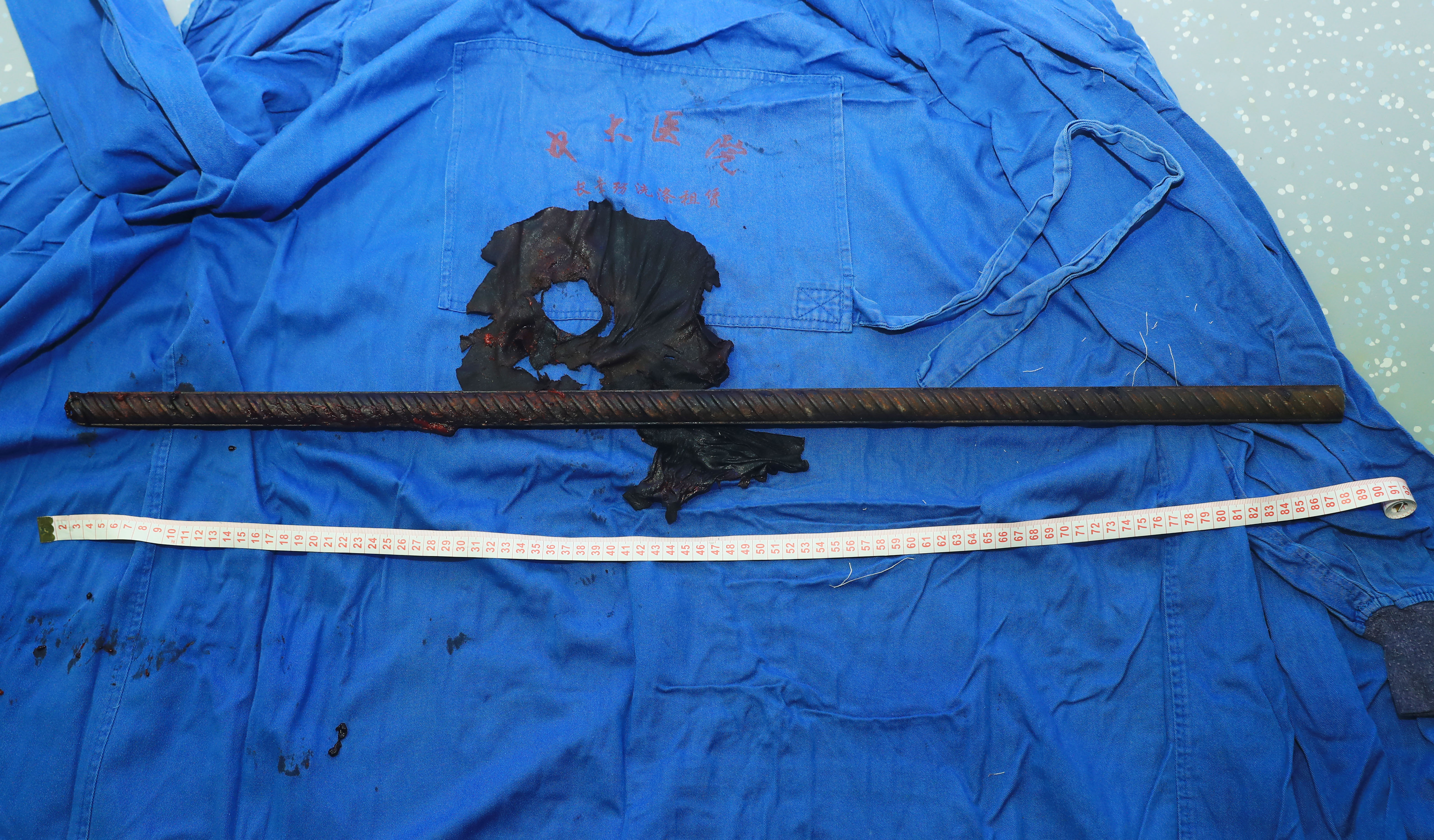 突发:90厘米长钢筋从会阴部插入穿腹入背结局:中大医院创伤中心多学科抢救化险为夷