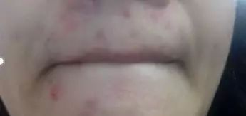 不停地方长痘原因分析,长痘的原因及调理方法在线咨询