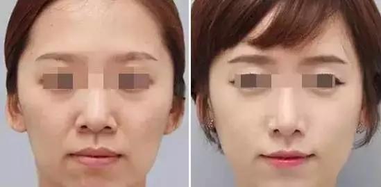 这辈子都不要去碰的四个医美项目,40岁后医美项目这样选