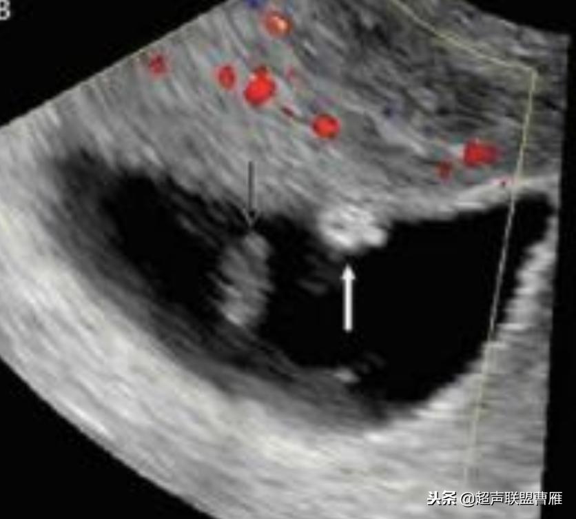 3毫米卵黄囊未见胎芽正常么,40多天的卵黄囊