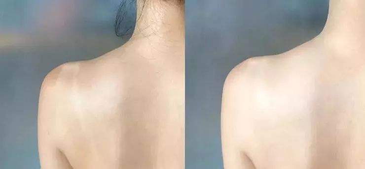 七岁小孩遗传鸡皮肤怎么治疗,鸡皮肤解决方法0成本