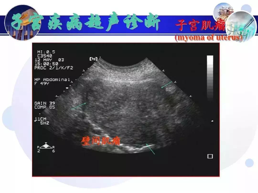纯干货！子宫及附件解剖和超声诊断