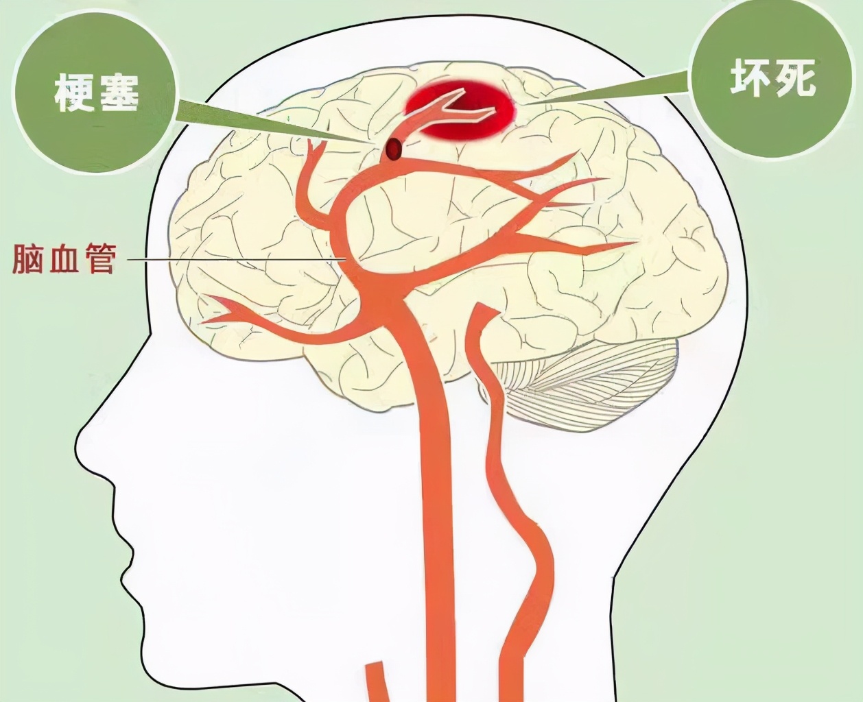 什么是脑梗有哪些症状,什么是脑梗脑梗塞需要注意什么