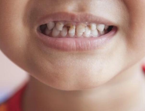 宝宝牙齿不整齐与喝奶嘴有关系吗,两周半的宝宝牙齿烂了掉落