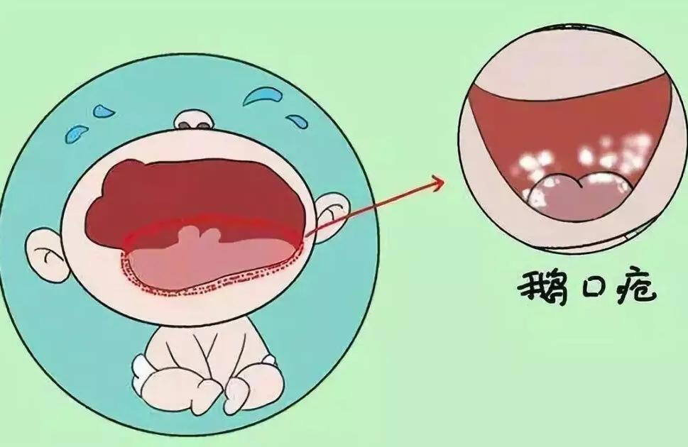 奶垢?鹅口疮?家长要分得清,才能及时治疗!