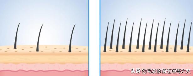 毛囊脱发怎么治疗最有效,治疗脱发有什么办法吗