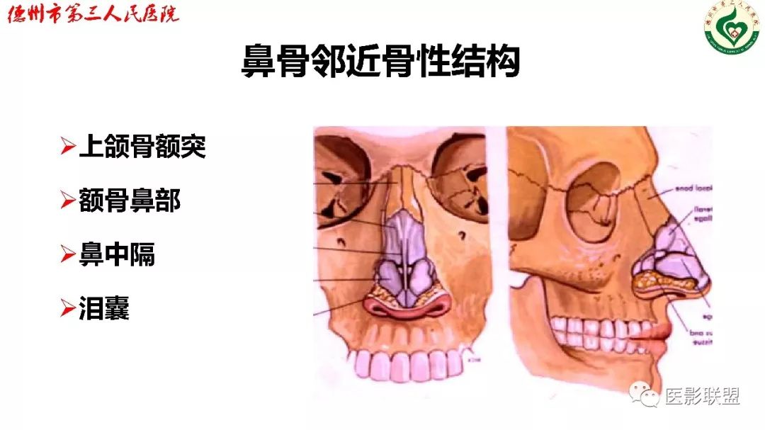 鼻骨骨折影像,鼻骨骨折dr影像表现