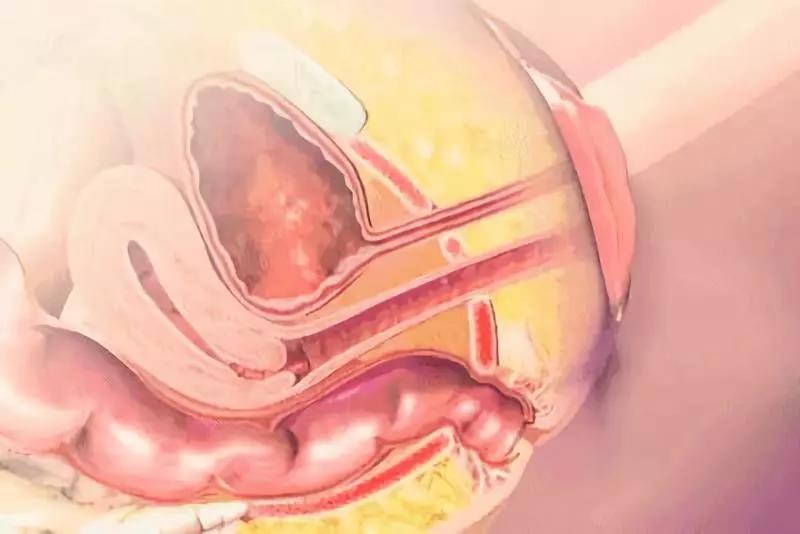 盆底肌修复千万不要“留”到二胎后做