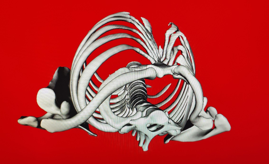 胸廓畸形矫正术后恢复,再创奇迹