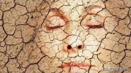 冬天换季干燥脱皮爆痘,冬季干燥泛红脱皮敏感爆痘怎么办