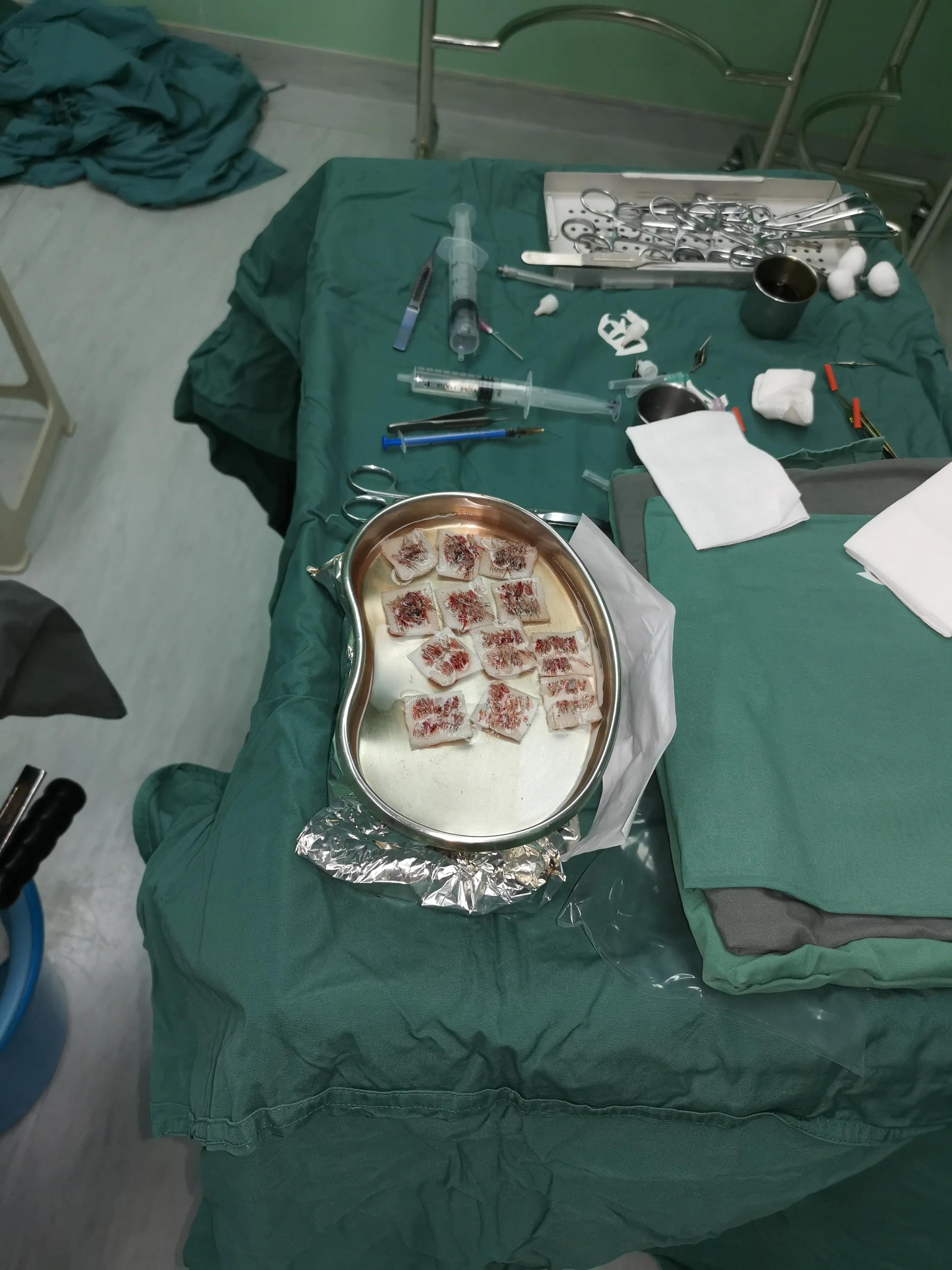 华山医院植发费用2020,2020植发视频