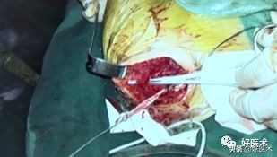 治疗肩锁关节脱位，有最好的方法吗？