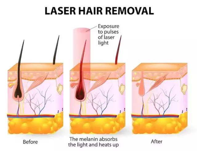 8种脱毛方法了解一下,5种最靠谱的脱毛方法