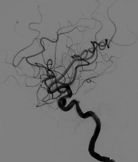 Tubridge®治疗多发性动脉瘤
