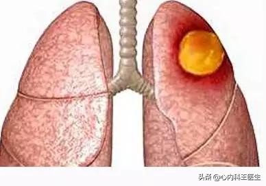 男性65岁咳嗽咳痰2个月病例,男的咳嗽被查出肺癌