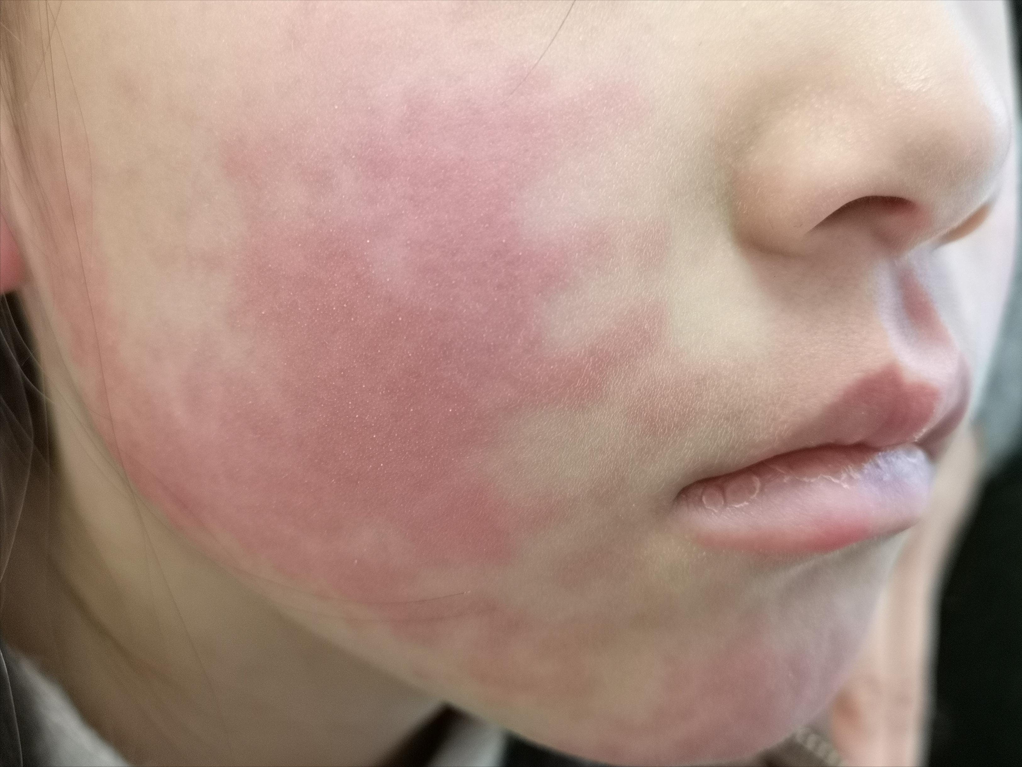 用药了为什么还是有点痒,药物过敏性皮疹痒怎么处理