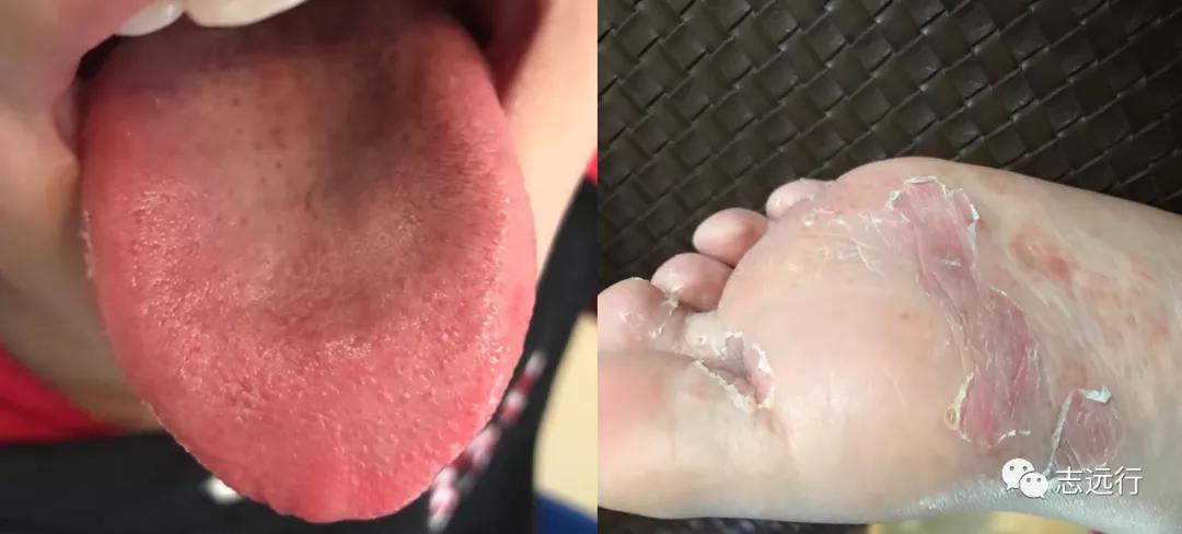 张景明治疗手足癣的中药方,一个治疗手足癣的好方子