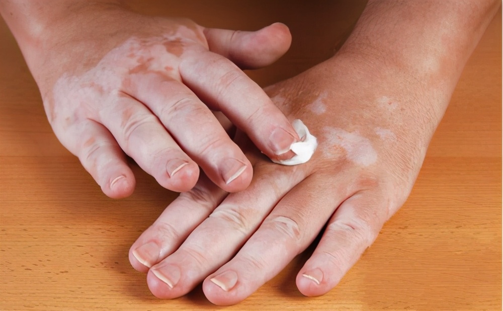 白癜风吃药治疗后为何变白,白癜风用药40天变化不大怎么办