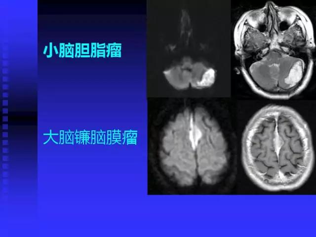 头颅mri读片视频教程,颅脑mri读片入门教程视频讲解全集