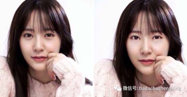 卧蚕整形可以去眼袋吗,眼袋和卧蚕整形前后对比