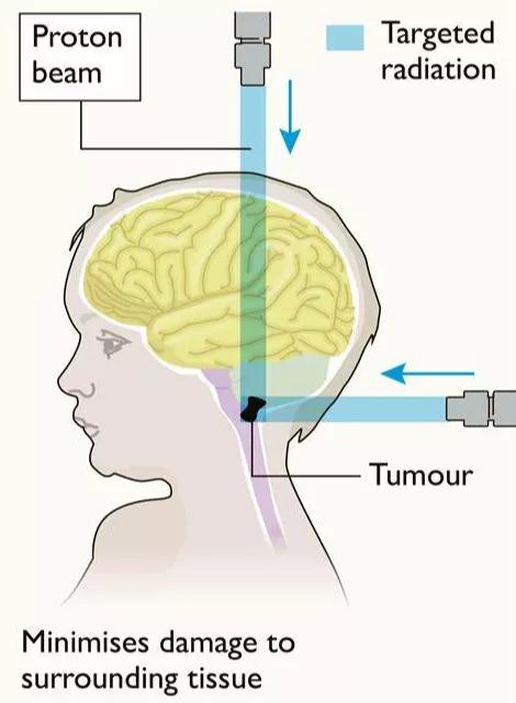 质子放疗治疗后的副作用,质子放疗对人体的损伤