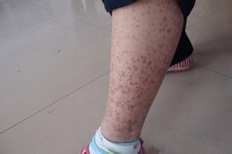 有过敏紫癜是不是更容易得血液病,过敏性紫癜是不是血液系统疾病