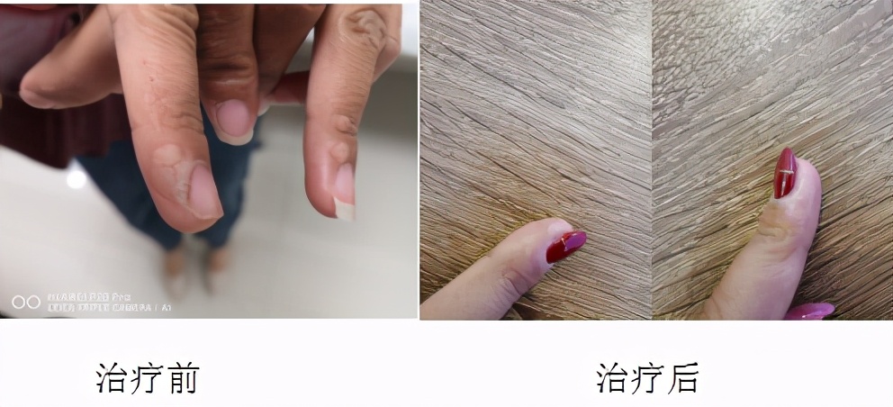 锶敷贴治疗血管瘤,90锶敷贴治疗血管瘤费用