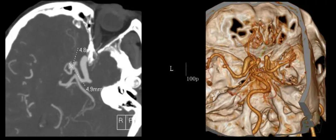突然头疼要炸了怎么回事,睡觉突然头疼剧烈要炸了