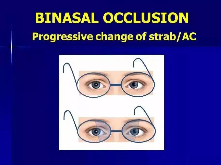 内隐斜最佳矫正方法,内隐斜视配镜