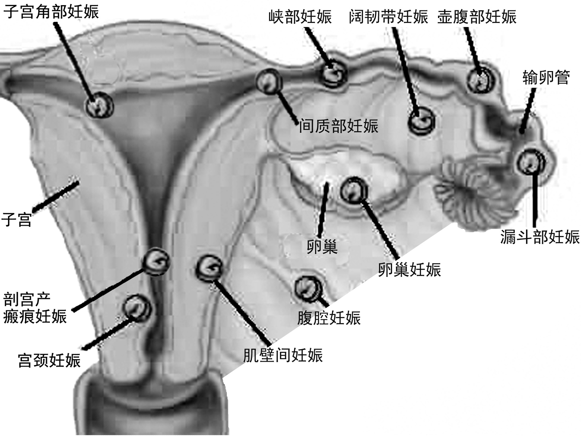 明明白白做超声32-4:异位妊娠