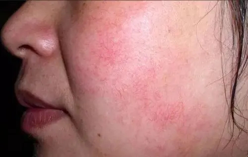 脸部有红血丝怎么处理好,天生脸部红血丝泛红严重怎么办