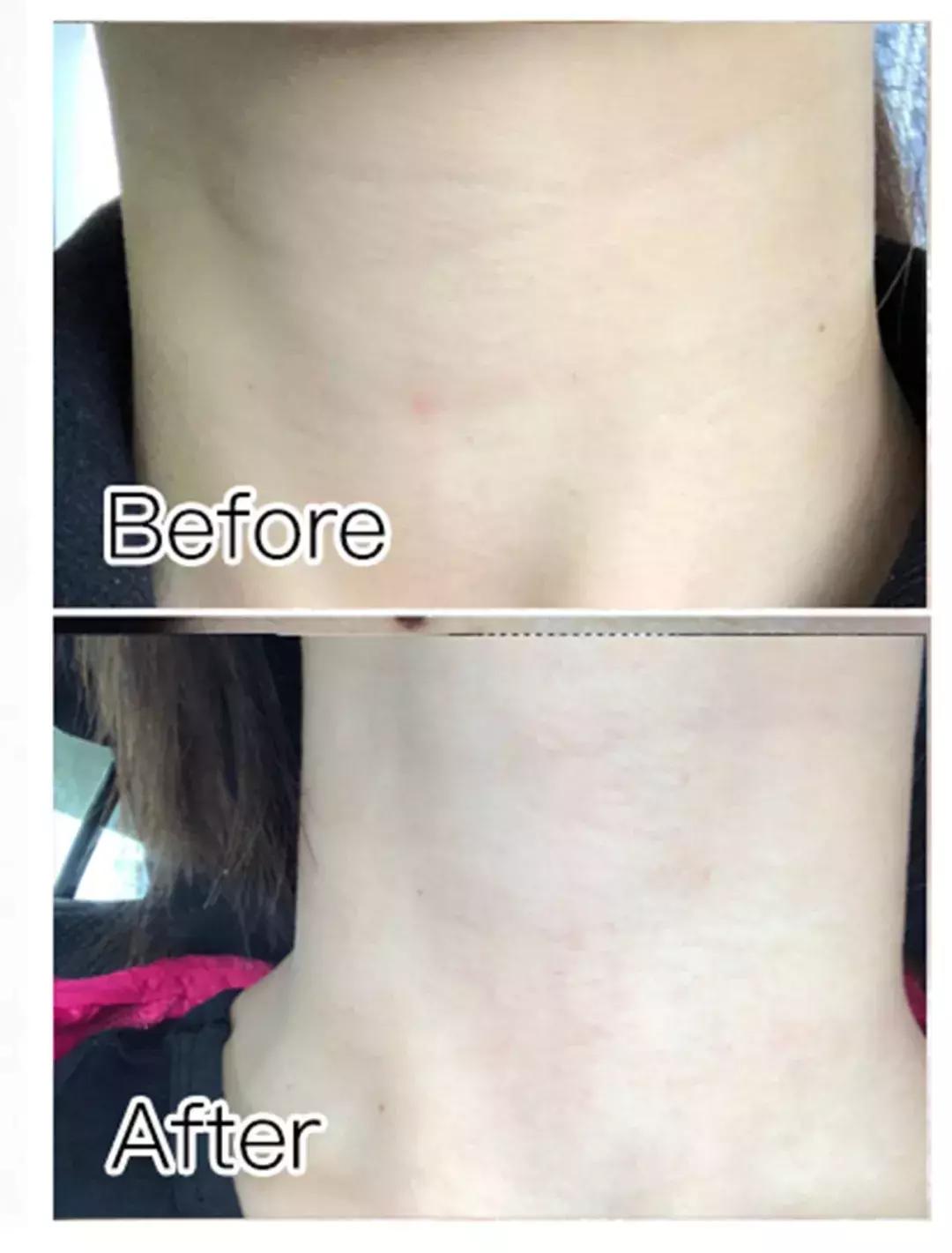 目前去颈纹比较好的方法,去颈纹有没有什么好的产品