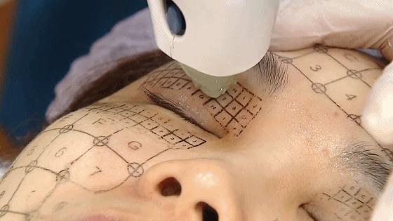 假体材料都有哪几种,假体材料都有什么