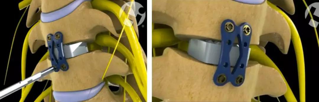 颈椎病是保守治疗还是手术治疗好,颈椎病做什么手术比较安全