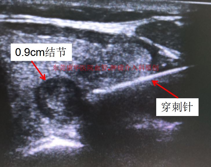 哈尔滨微创消融甲状腺结节哪家好,甲状腺结节微创消融术的过程
