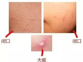 长了粉刺怎么处理,长了闭合粉刺性痤疮怎么办