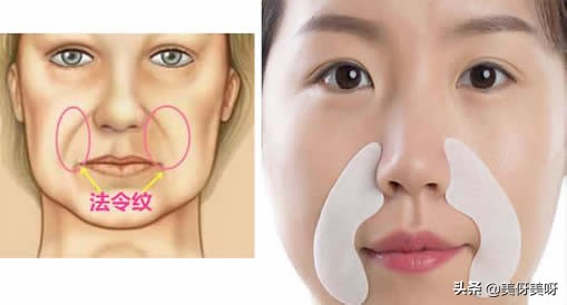 法令纹怎么消除最快简单,为什么会有法令纹怎样才能消除