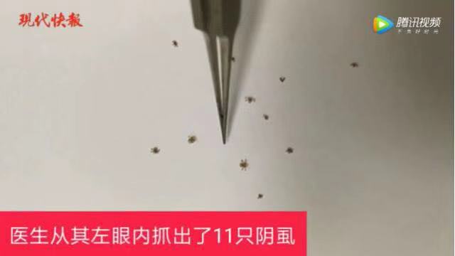 小孩子睫毛感染阴虱,杭州六岁孩子睫毛长阴虱